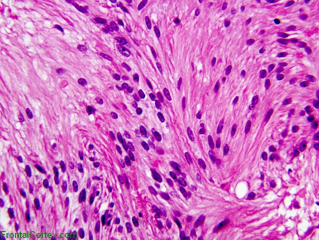 Myxopapillary ependymoma x 400